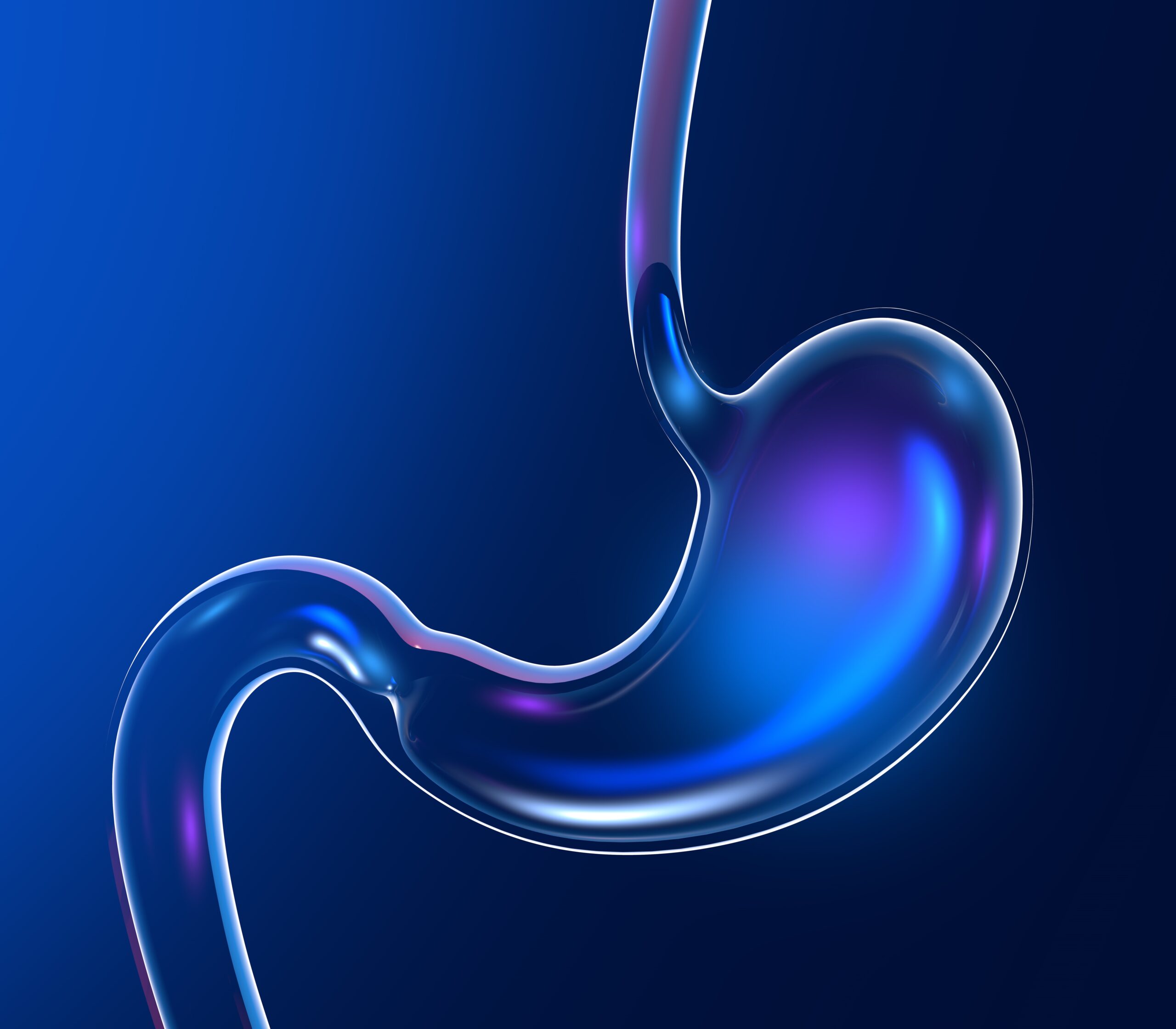 3D απεικόνιση στομάχου που χρησιμοποιείται για ενημέρωση σχετικά με πολύποδες στομάχου και ενδοσκοπική αφαίρεση.